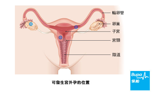 Image - Etcopic pregnancy-Chi